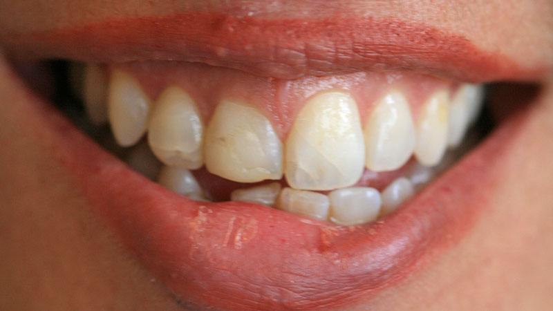 Before-Cosmetic dentistry crowns