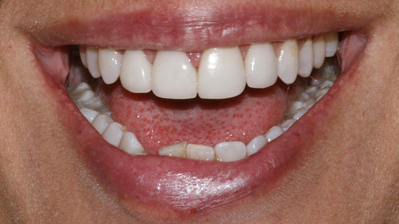 After-Cosmetic dentistry crowns