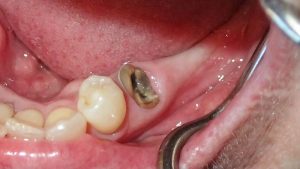 dental-implants-edentulous-space-before