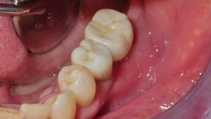 dental-implants-space-filled-after