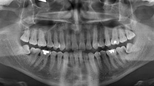 caries caused by wisdom teeth, wisdom teeth removal burnaby