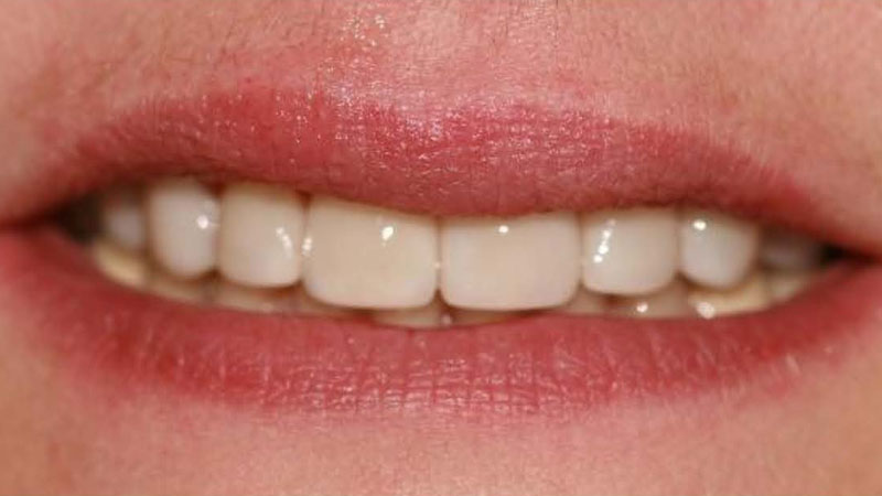 After-Anterior ceramic crowns