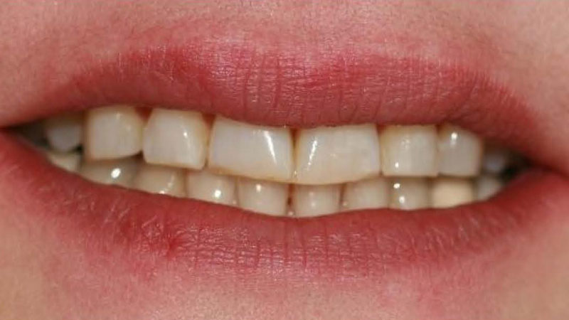 Before-Anterior ceramic crowns