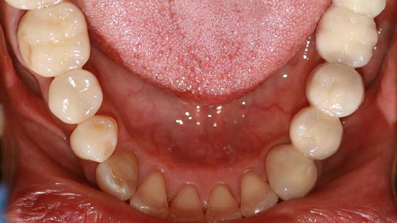 After-Dental implants bridges to restore function