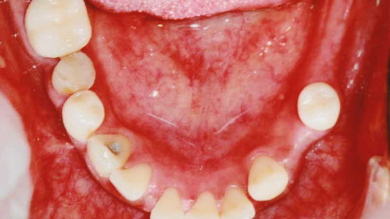 Before-Dental implants bridges to restore function