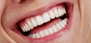 We offer bonding, enamel-coloured crowns, bridges, dental implants and veneers in Burnaby, BC.