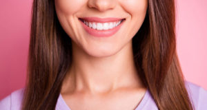 Veneers Burnaby dentist South Burnaby - How to Care for Veneers